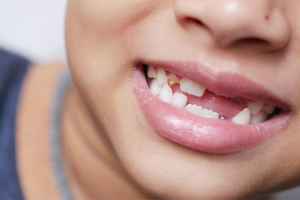 What to do if your child chips a tooth.